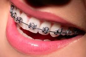 Aparelho Ortodôntico Convencional Metálico